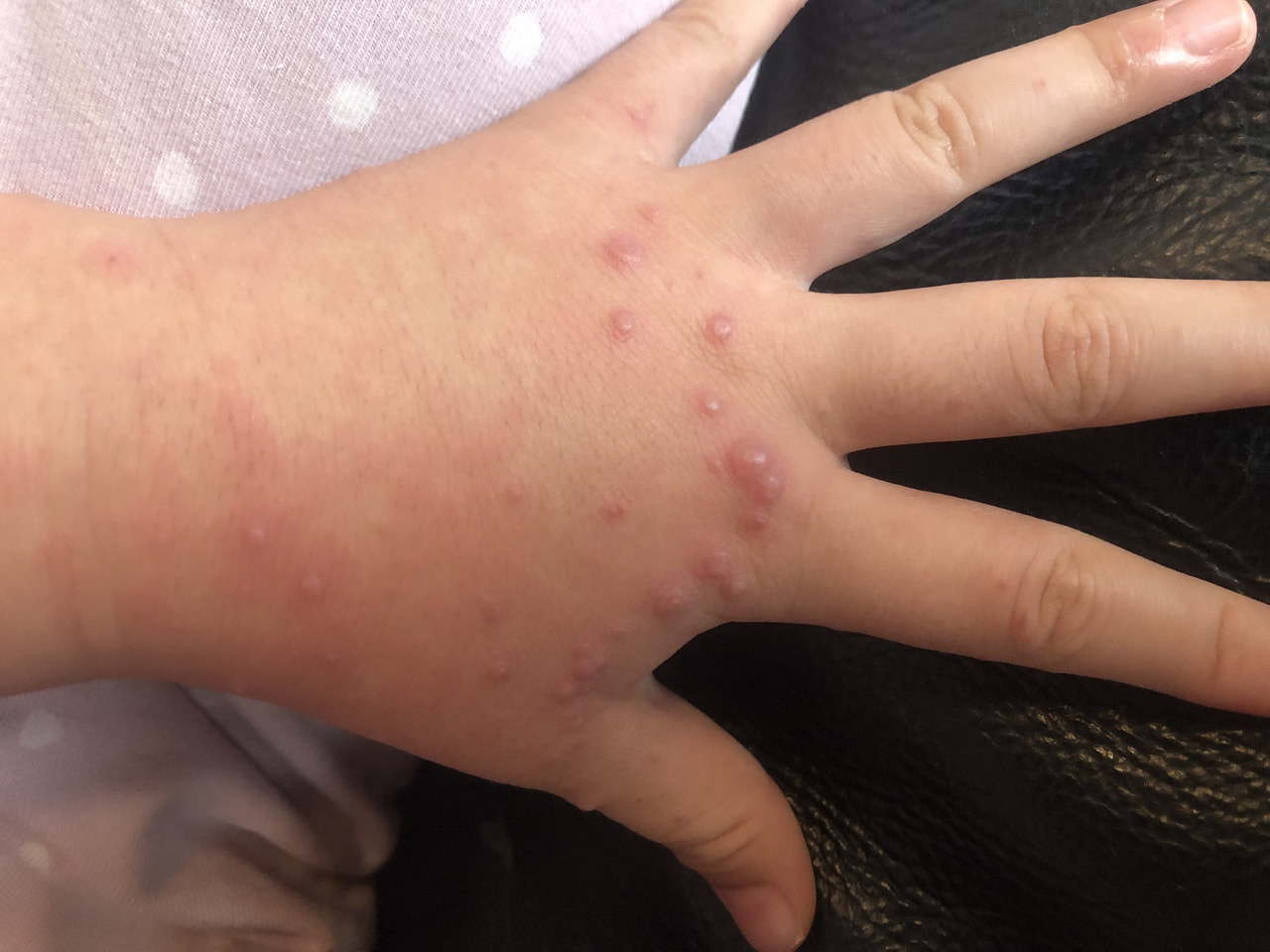 岐阜県は９日、子どもを中心に手足や口に発疹する「手足口病」の患者数が急増して警報...